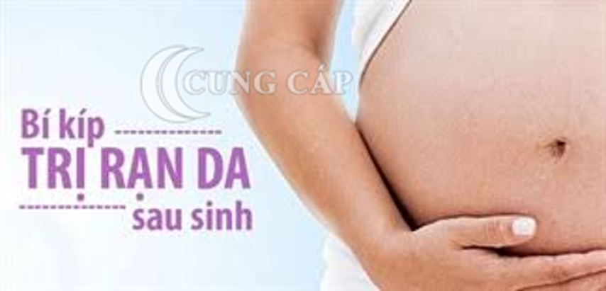Những phương pháp trị rạn da sau sinh cho mẹ bỉm tại nhà