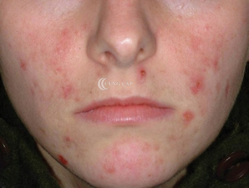 Mẹo điều trị thâm da ở nhà