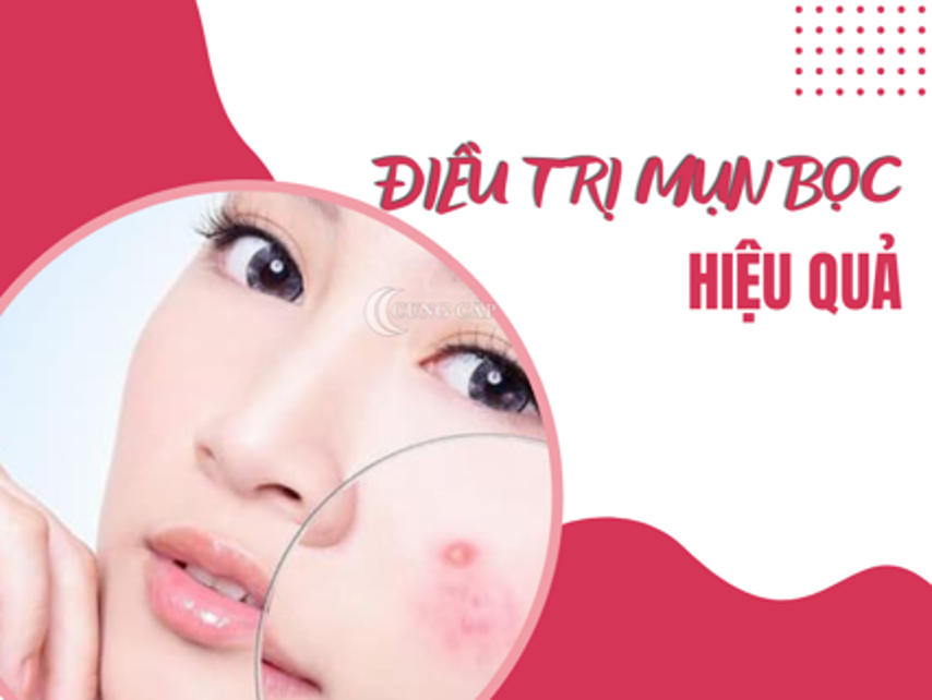 3 Mẹo trị mụn bọc từ tự nhiên