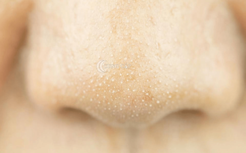 Một số loại trái cây có thể điều trị mụn