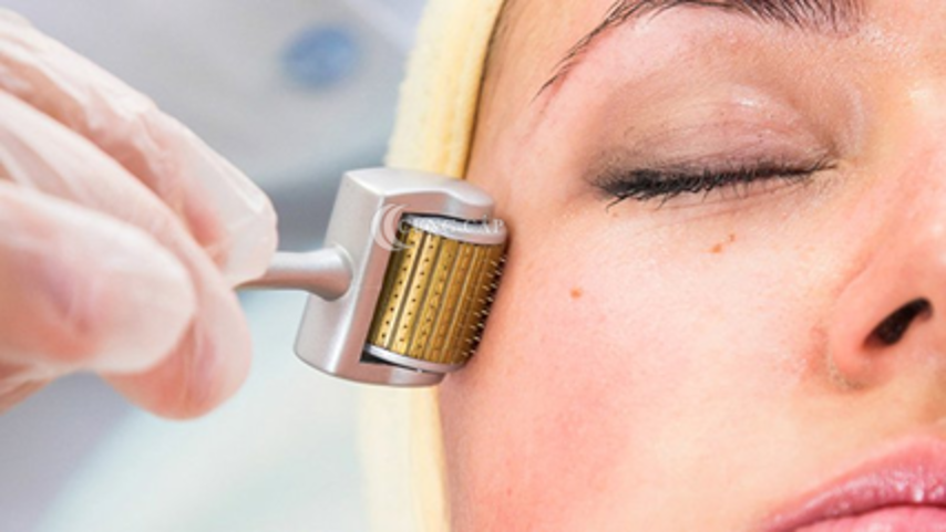 Chăm sóc da sau lăn kim trị mụn chú ý điều gì