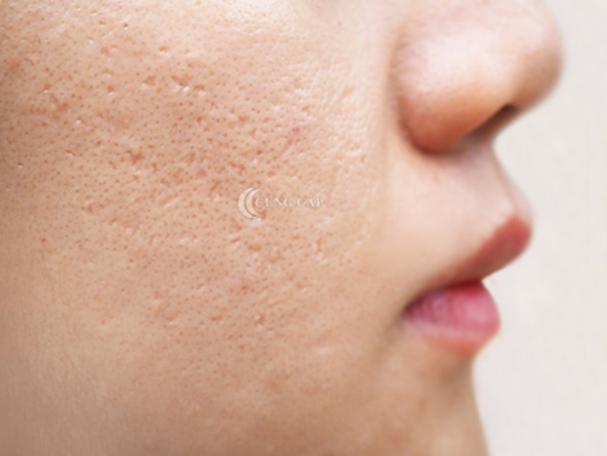 Sẹo lõm, sẹo rỗ là gì? Có trị dứt điểm được không?