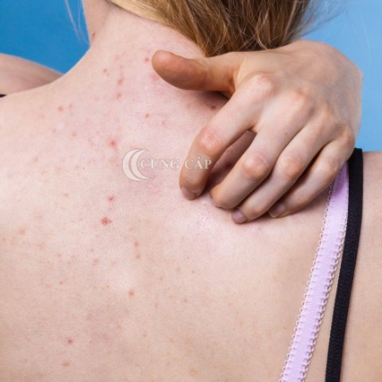 trị mụn lưng cần chú ý điều gì