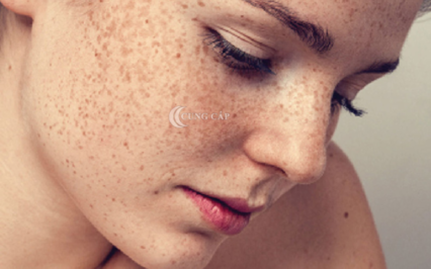 trị nám tận gốc tại spa