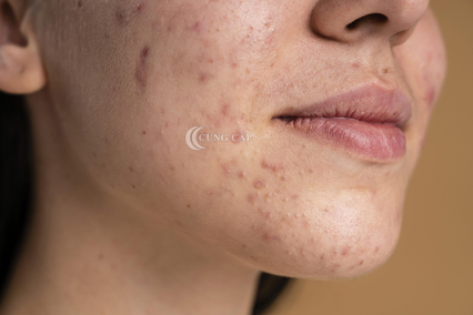 vì saovết thâm lại có sau mụn
