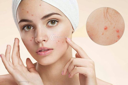 Làm giảm sưng to mụn đạt hiệu quả trong 1 đêm