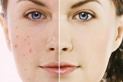 Giải pháp trị mụn quanh miệng ở nhà an toàn, hiệu quả