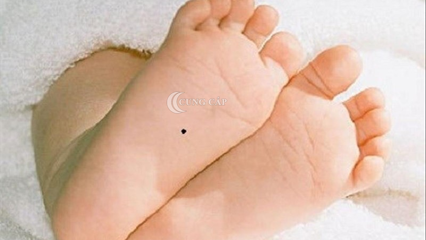 nốt ruồi dưới bàn chân thể hiện gì
