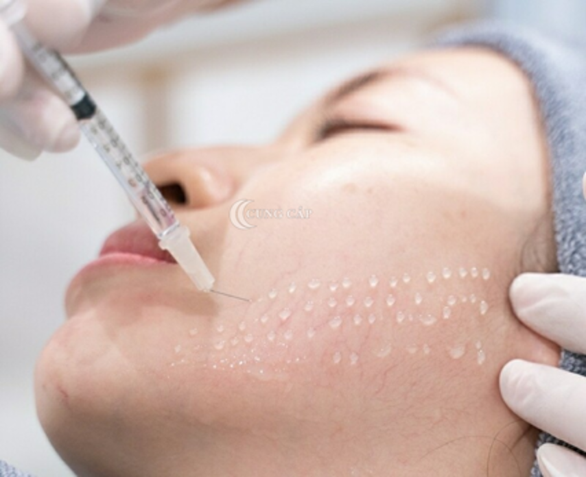 cấy meso bao lâu một lần