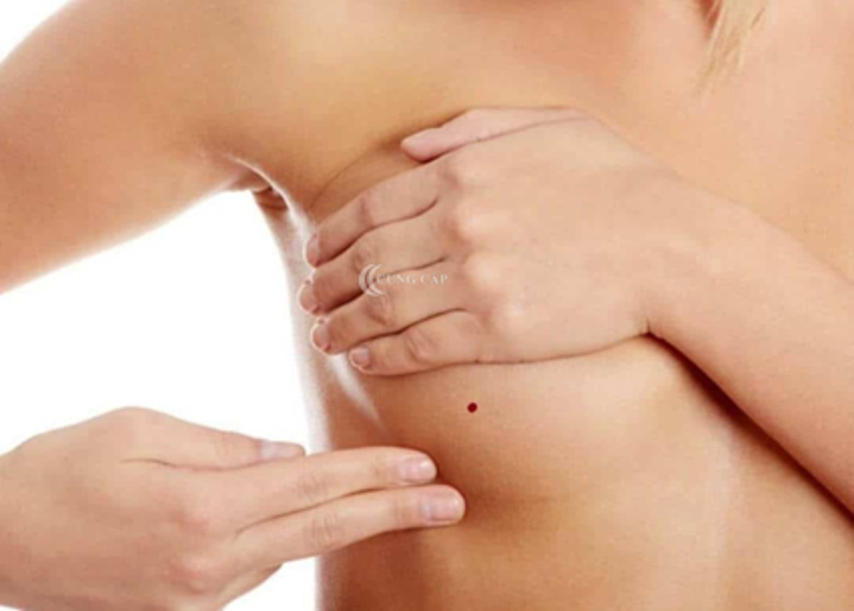 Ý nghĩa nốt ruồi ở ngực phải